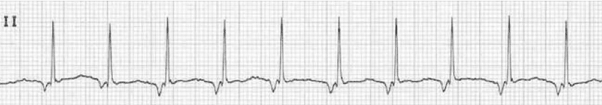 An EKG strip displaying accelerated junctional rhythm, characterized by a regular heart rate with narrow QRS complexes and absent or inverted P waves.