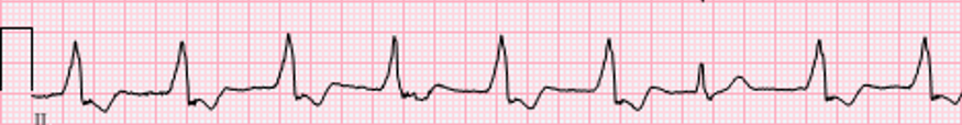 A 6-second rhythm strip depicting accelerated junctional rhythm. Characteristics shown include an absent or hidden P wave, normal QRS intervals, and a rate between 60–100 beats per minute.