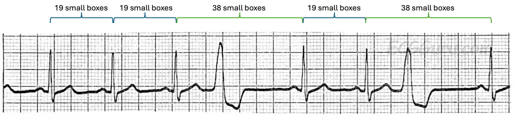 Ventricular Arrhythmias – EKG Essentials: A Student Handbook