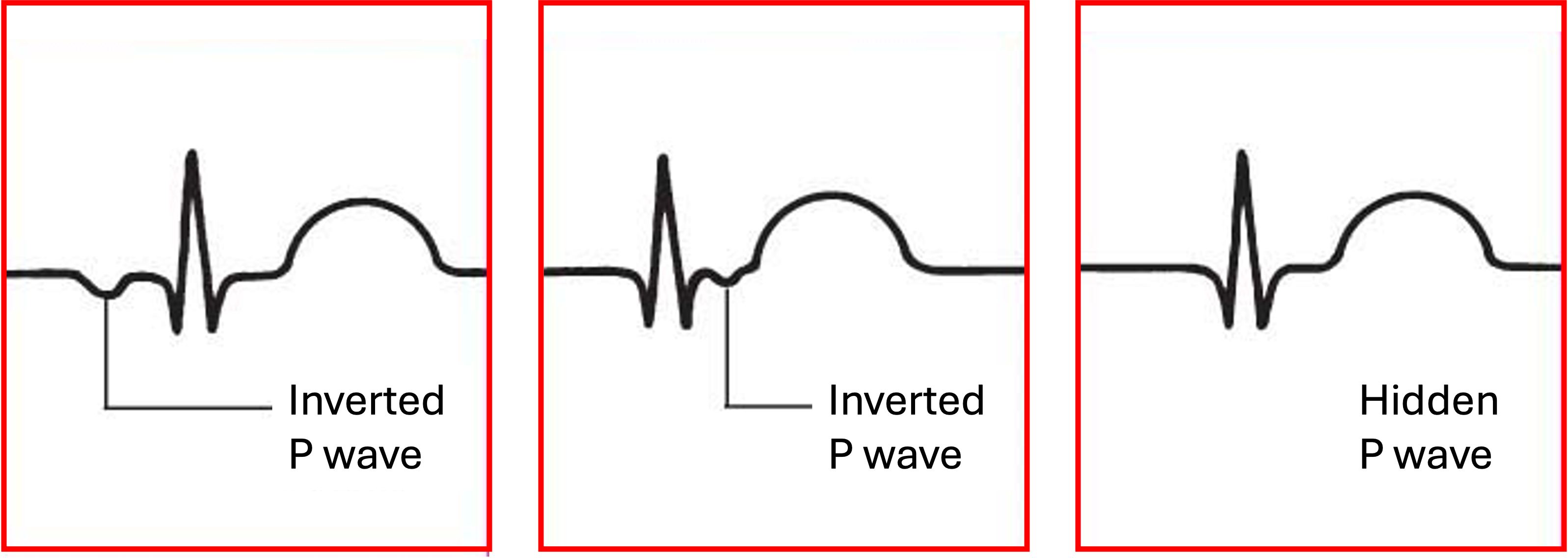 Examples of the three P wave morphologies from a premature junctional contraction.