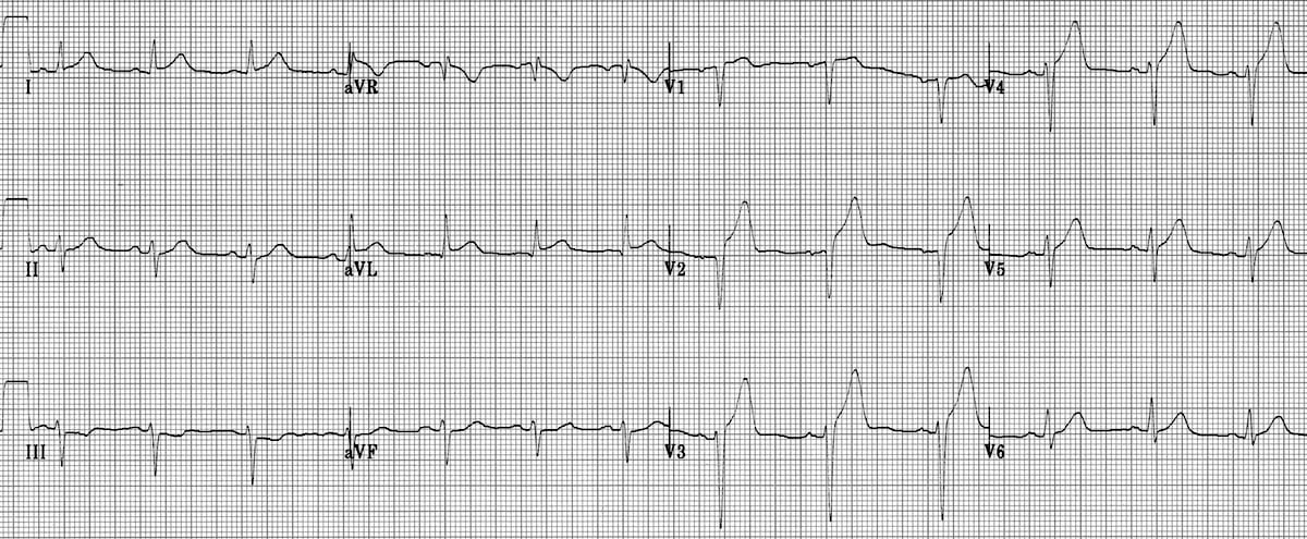 A 12-lead EKG showing anteroseptal ST elevation myocardial infarction (STEMI) with hyperacute T waves. This EKG displays deep QS waves in V1 and V2, hyperacute T waves in V2–V4, and ST segment elevation in V2–V4.