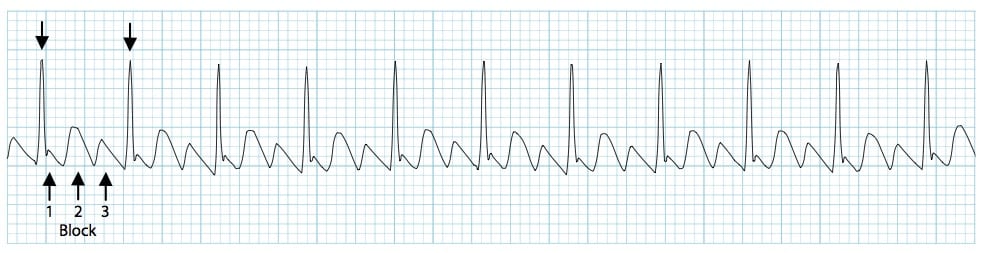 A rhythm strip showing atrial flutter with a 3:1 conduction ratio, or block. The EKG displays rapid atrial depolarization waves (flutter waves) with three flutter waves occurring for every one QRS complex, as indicated by arrows.