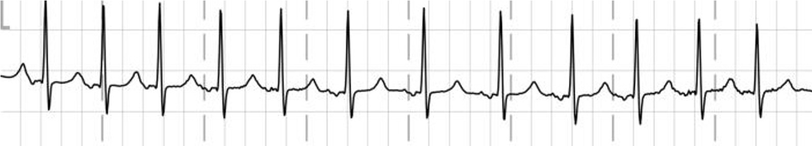 A EKG tracing illustrating atrial tachycardia with consistent and narrow QRS complexes and frequent, abnormal P waves.