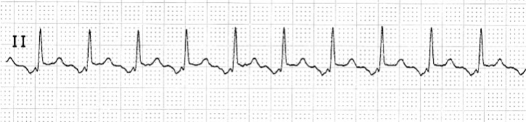 An EKG tracing illustrating atrial tachycardia, characterized by a rapid heart rate with abnormal P waves preceding each QRS complex.