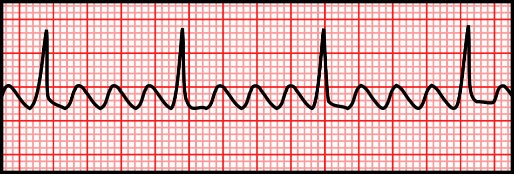 Atrial Arrhythmias – EKG Essentials: A Student Handbook