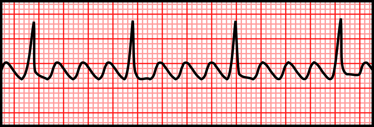 A 3-second rhythm strip depicting atrial flutter (3:1 conduction)