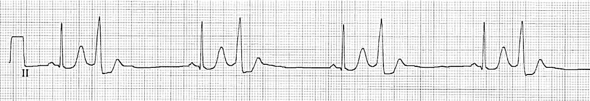 Rhythm strip showing a premature ventricular contraction every second beat.