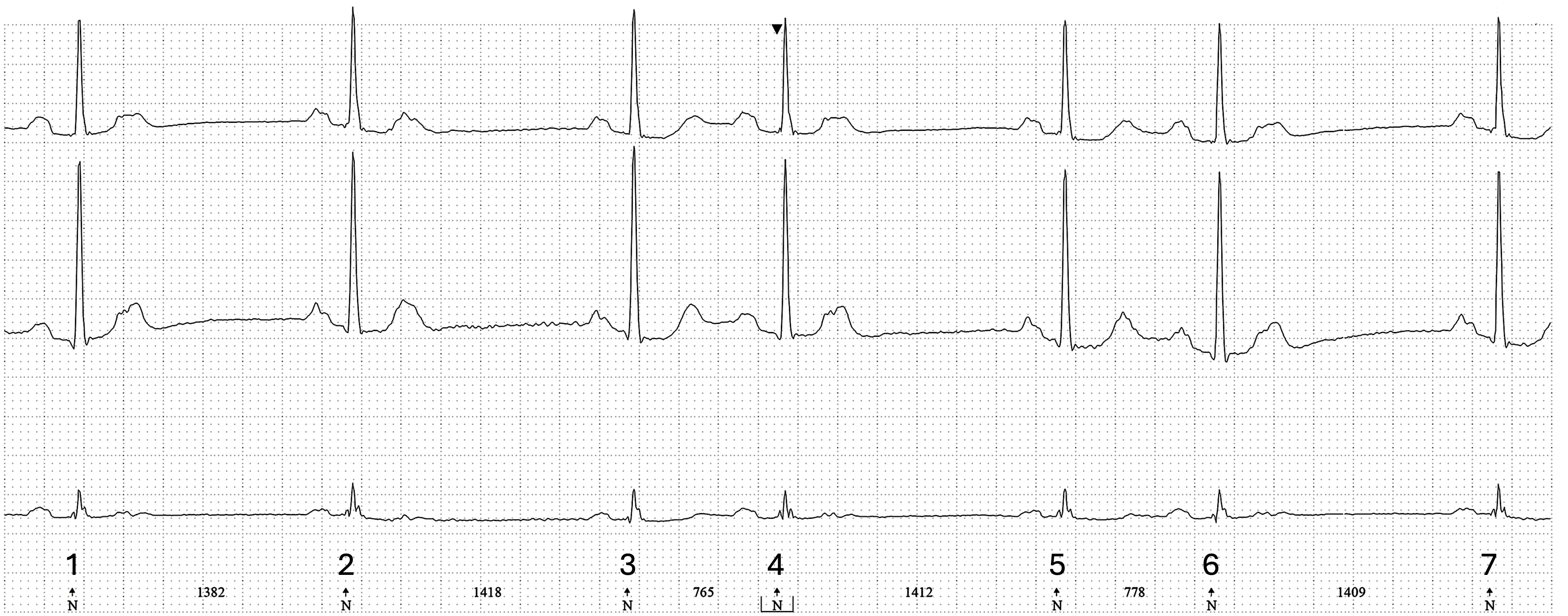 An EKG tracing illustrating blocked premature atrial contractions (PACs), characterized by P waves that occur earlier than expected but are not followed by QRS complexes.