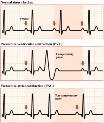 Ventricular Arrhythmias – EKG Essentials: A Student Handbook