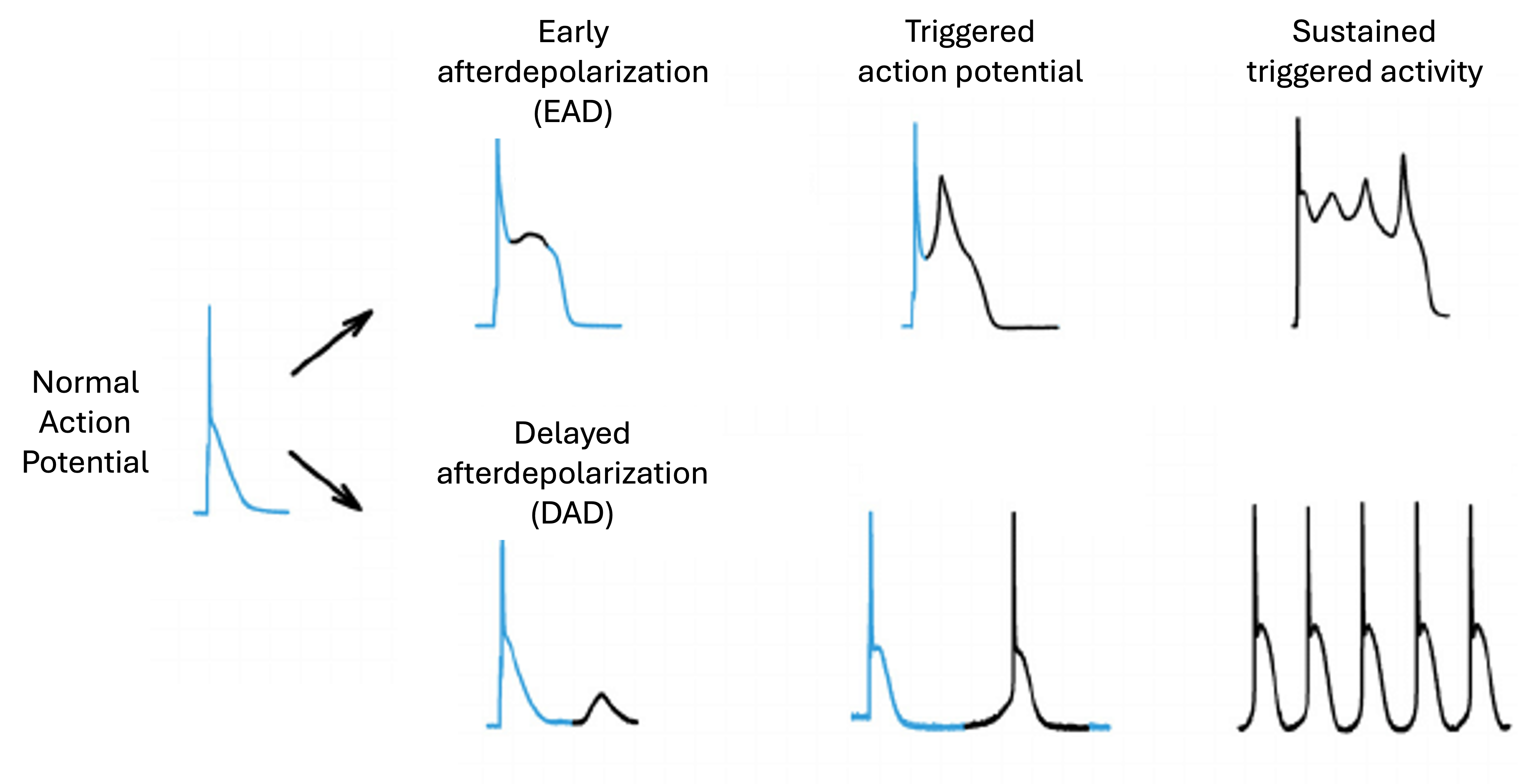 A diagram showing the progression of normal cardiac action potential to early afterdepolarization (EAD) and delayed afterdepolarization (DAD), leading to triggered action potentials and sustained triggered activity. The images illustrate how disturbances in the normal action potential can lead to abnormal cardiac electrical activity.