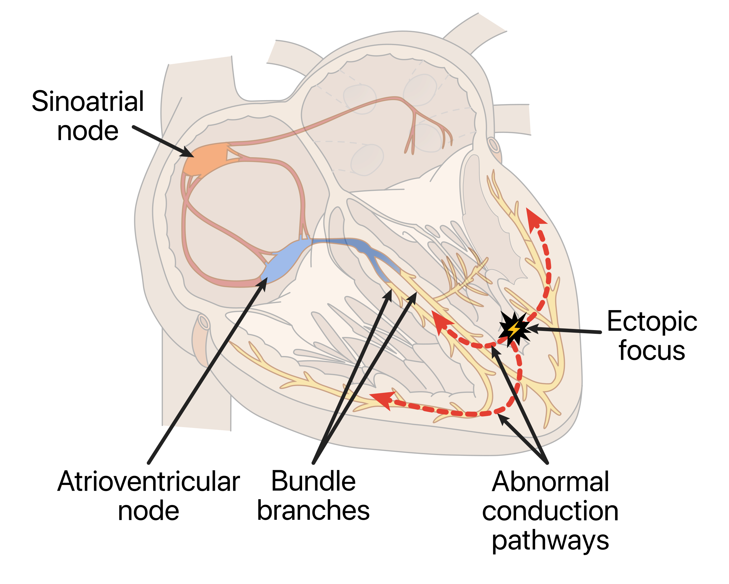 Diagram of the heart illustrating the conduction system with an emphasis on an ectopic focus disrupting the normal electrical pathway with arrows showing the typical flow of the electrical impulses and the abnormal pathway caused by the ectopic focus.