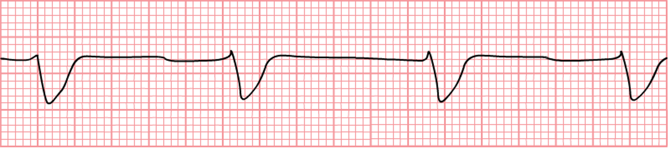 An EKG tracing illustrating idioventricular rhythm, characterized by a slow heart rate with wide QRS complexes and no P waves.