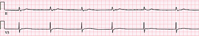 An EKG tracing illustrating junctional escape rhythm in leads II and V5, characterized by regular, narrow QRS complexes and absent or inverted P waves.