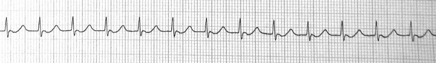 An EKG tracing illustrating junctional tachycardia, characterized by a heart rate greater than 100 beats per minute with narrow QRS complexes and absent or inverted P waves. The ECG grid background shows consistent, closely spaced intervals, indicating the heart's rhythm is originating from the AV junction at an accelerated rate.