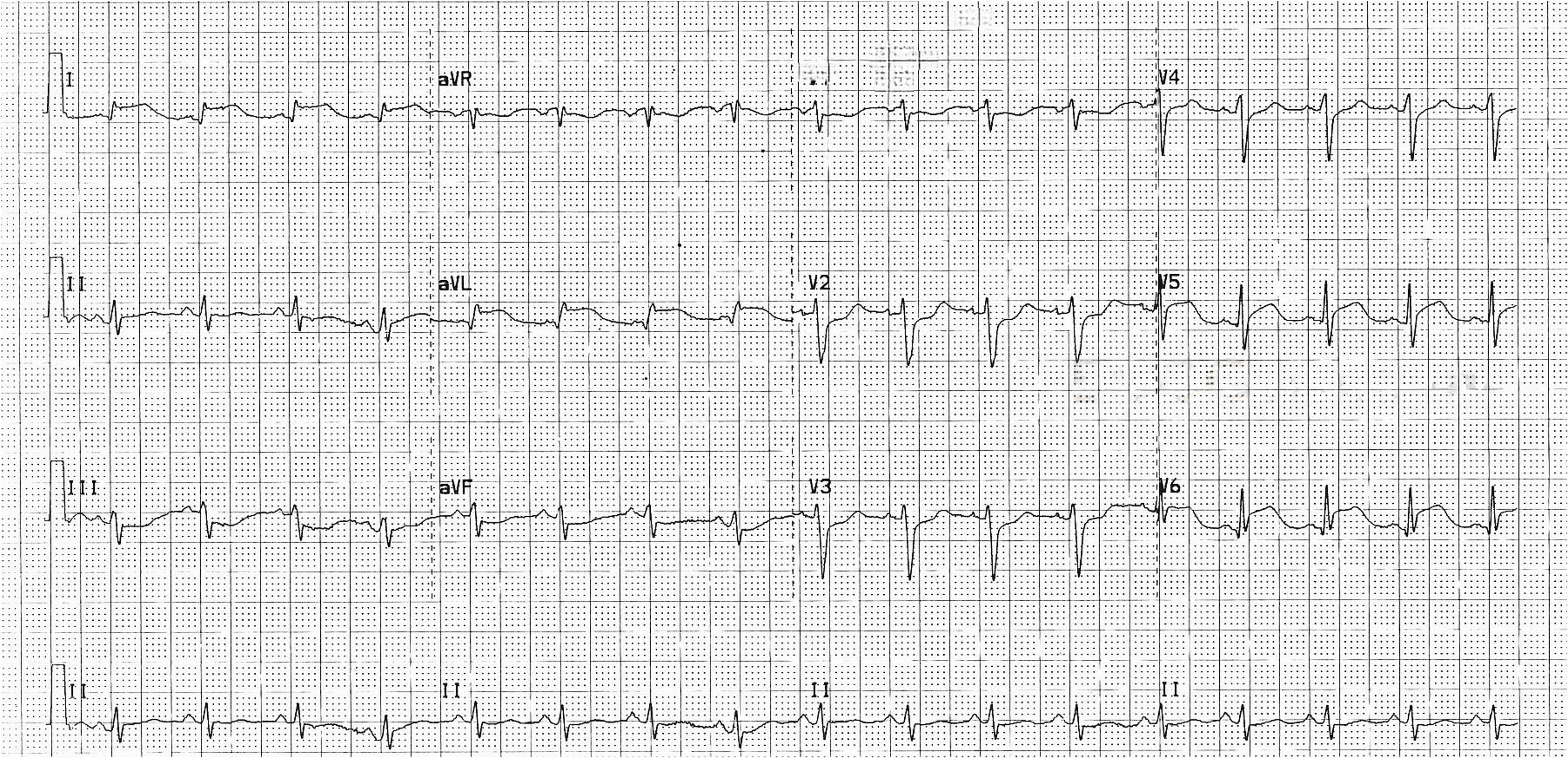 A 12-lead EKG displaying lateral ST segment elevation myocardial infarction (STEMI) with reciprocal changes. The lateral leads (I, aVL, V5, V6) exhibit ST elevation along with reciprocal ST depression in leads III, aVF, and V1–V4. Q waves are also established in leads I, aVL, V5, and V6.