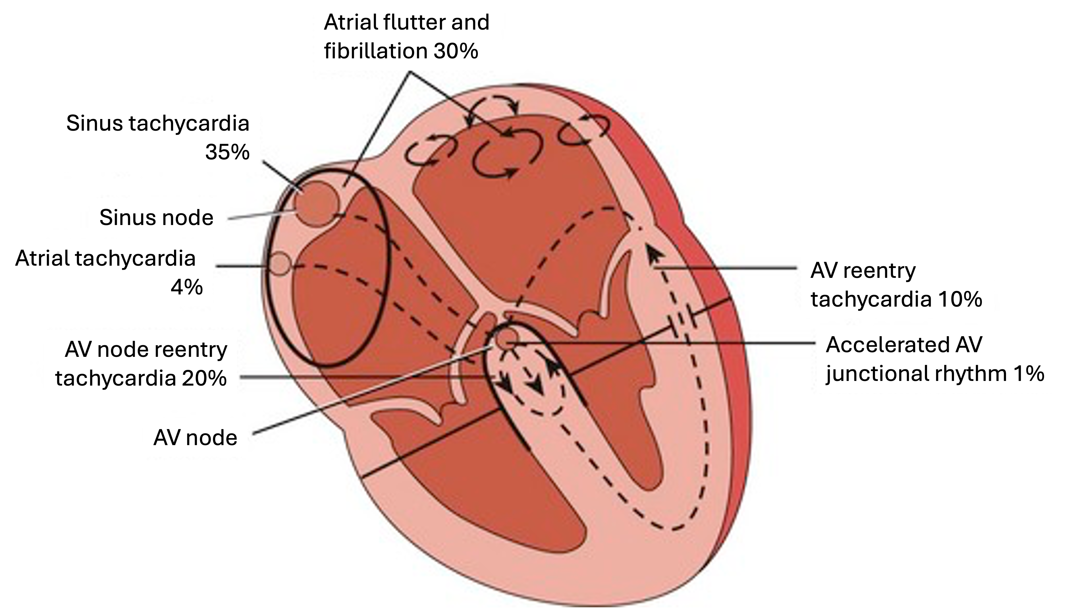 The layout of typical origins of supraventricular tachycardias around the heart