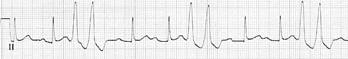 Rhythm strip showing PVC couplets