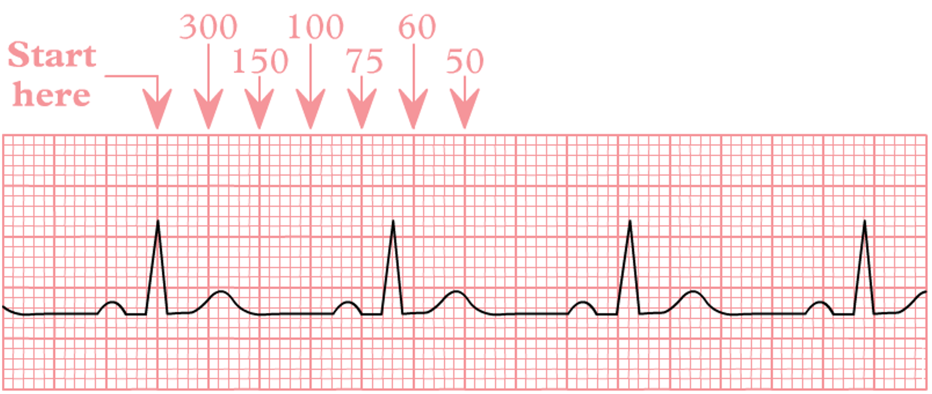 Example of the rapid estimation technique to estimate rate of a regular rhythm based on the number of large boxes between R waves.