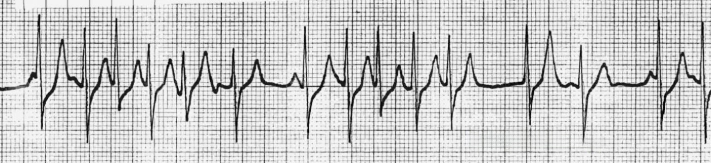 EKG rhythm strip depicting multifocal atrial tachycardia with varying P wave shapes and intervals, indicating multiple ectopic atrial foci driving the rhythm.