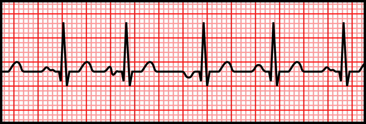 A 3-second rhythm strip depicting multifocal atrial tachycardia