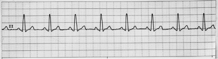 A 6-second rhythm strip showing normal sinus rhythm