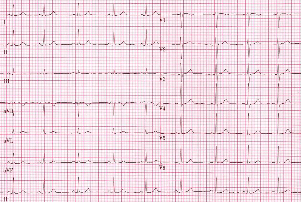 A 12-lead EKG displaying a normal sinus rhythm (NSR) with consistent P waves, QRS complexes, T waves, and normal ST-segments, indicating regular and normal heart function.