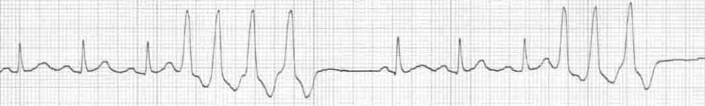 Rhythm strip showing non-sustained ventricular tachycardia and a PVC triplet.