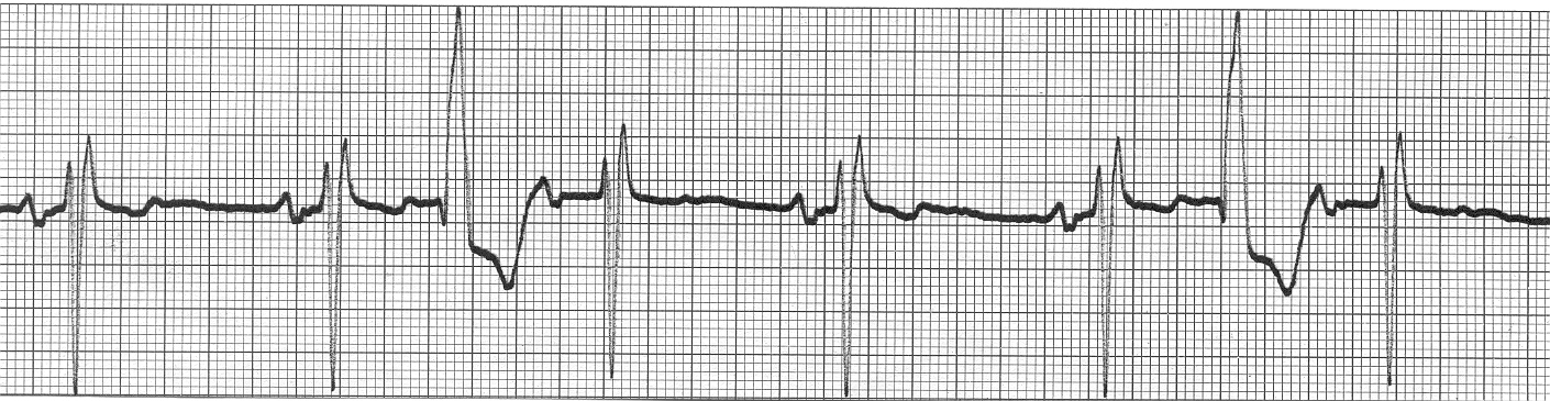 An EKG tracing illustrating an interpolated premature ventricular contraction (PVC), where the PVC occurs between two normal beats without interrupting the regular sinus rhythm.