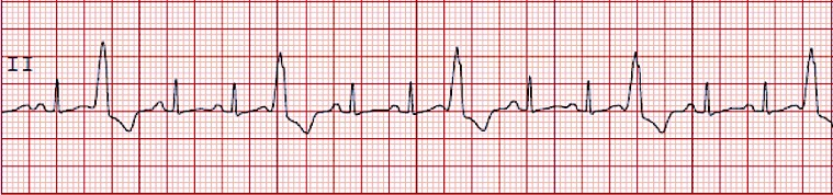 EKG tracing illustrating premature ventricular contractions (PVCs) occurring in a trigeminy pattern, where every third beat is a PVC.