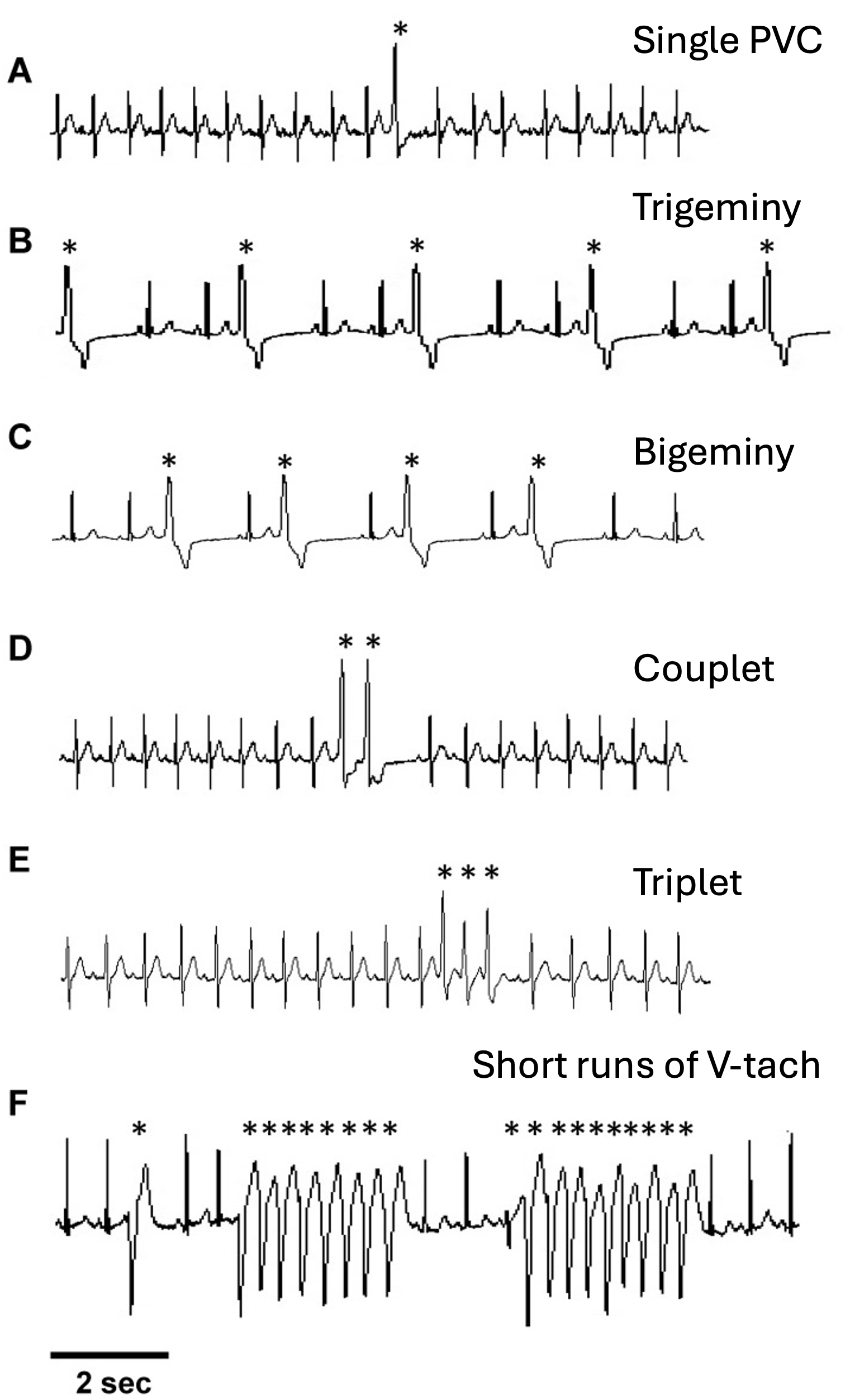 EKG tracings illustrating different types of premature ventricular contractions (PVCs) and a run of ventricular tachycardia (V-tach). The tracings include: A) Single PVC, B) Trigeminy, C) Bigeminy, D) Couplet, E) Triplet, F) Short runs of V-tach. Asterisks (*) mark the PVCs.