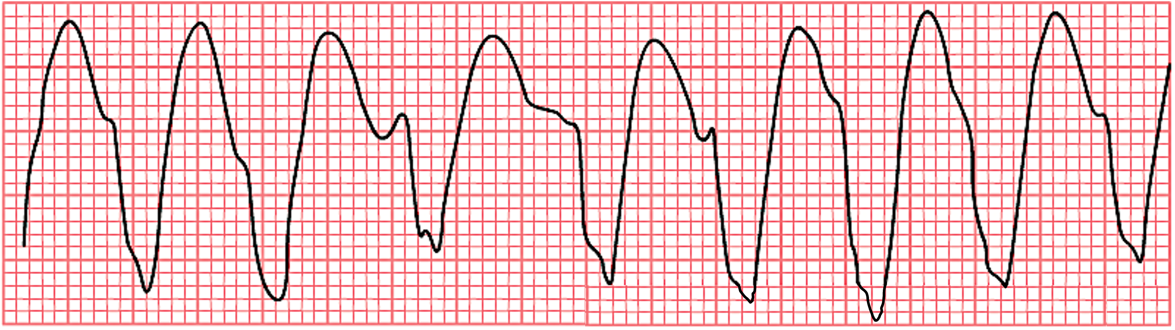 An EKG tracing depicting polymorphic ventricular tachycardia (V-tach), characterized by rapid and irregular QRS complexes of varying shapes and sizes.