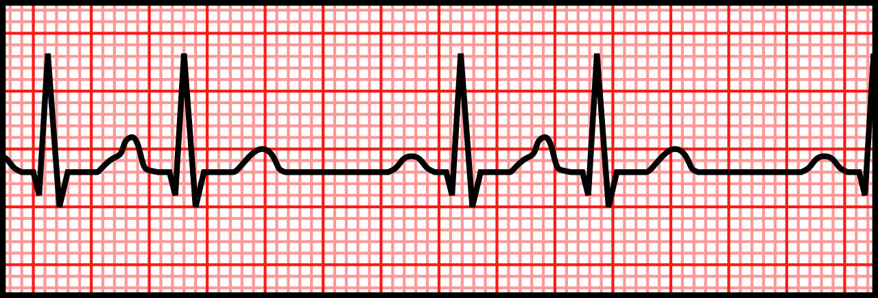 A 3-second strip depicting premature atrial contractions.