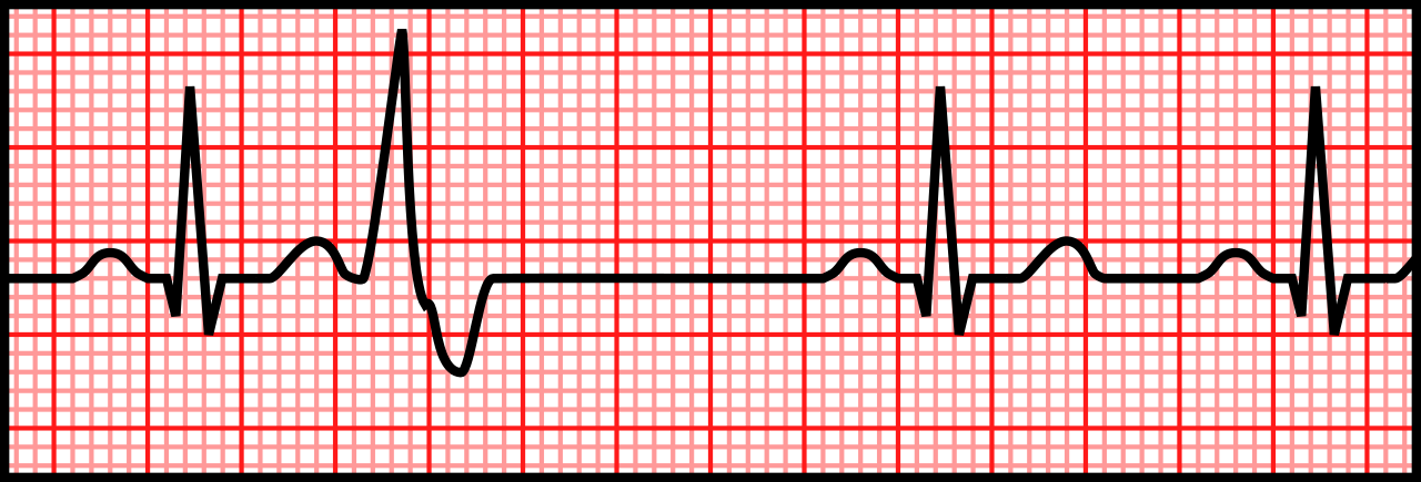 A 3-second rhythm strip depicting a normal sinus rhythm with a premature ventricular contraction