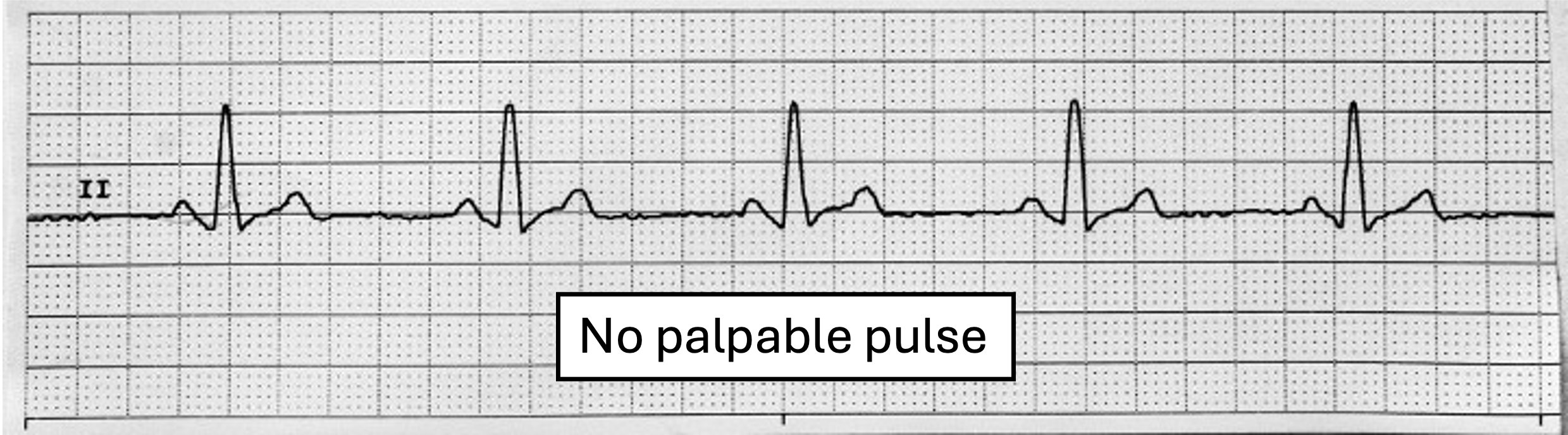 An EKG tracing displaying pulseless electrical activity (PEA), characterized by the presence of organized electrical activity on the EKG without a palpable pulse.