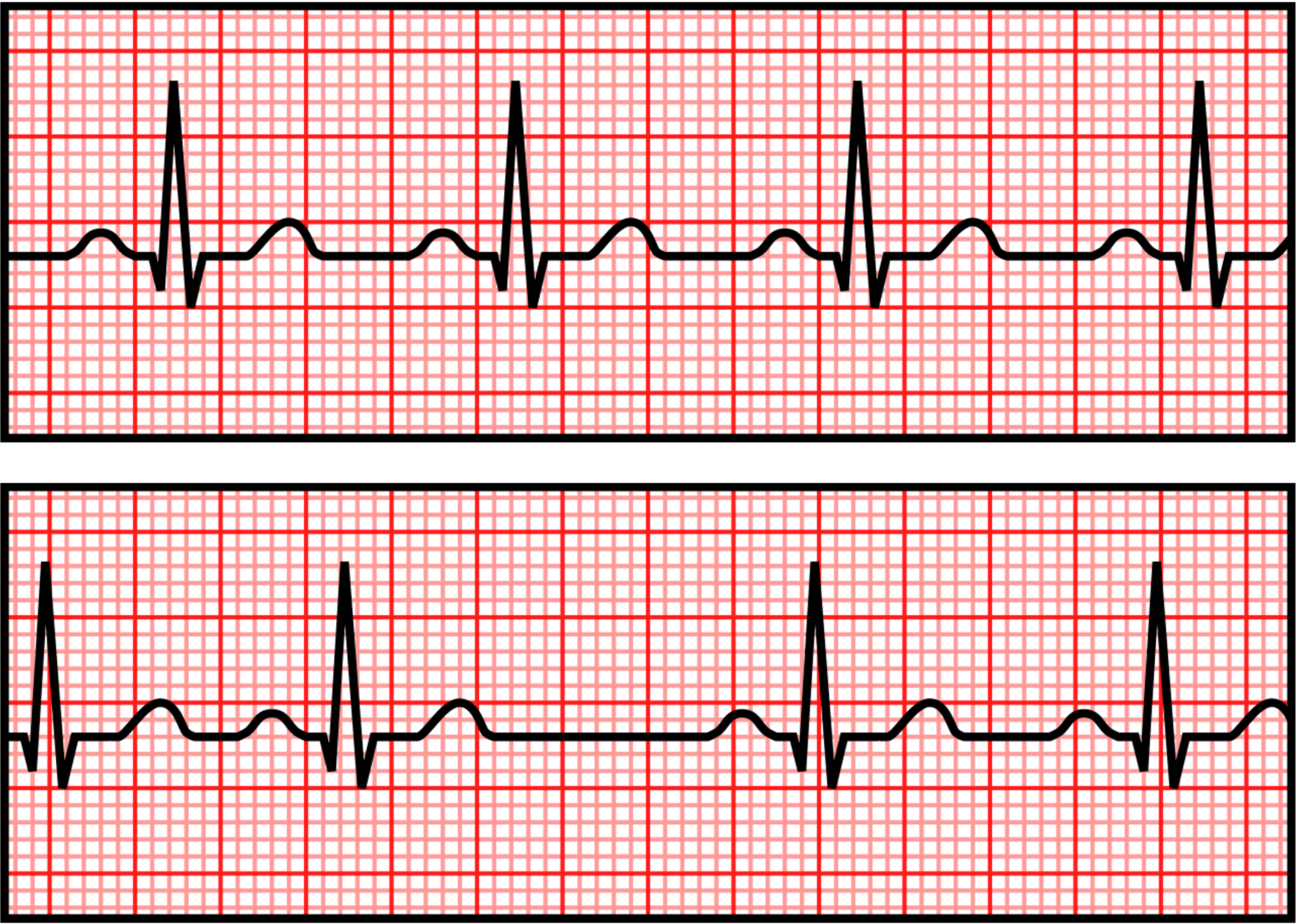 Two 3-second rhythm strips, the top strip depicts a normal rhythm and the bottom strip depicts an irregular rhythm.