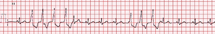 EKG rhythm strip showing a run of ventricular tachycardia (V-tach) with multiple consecutive wide QRS complexes indicative of a rapid ventricular rhythm.