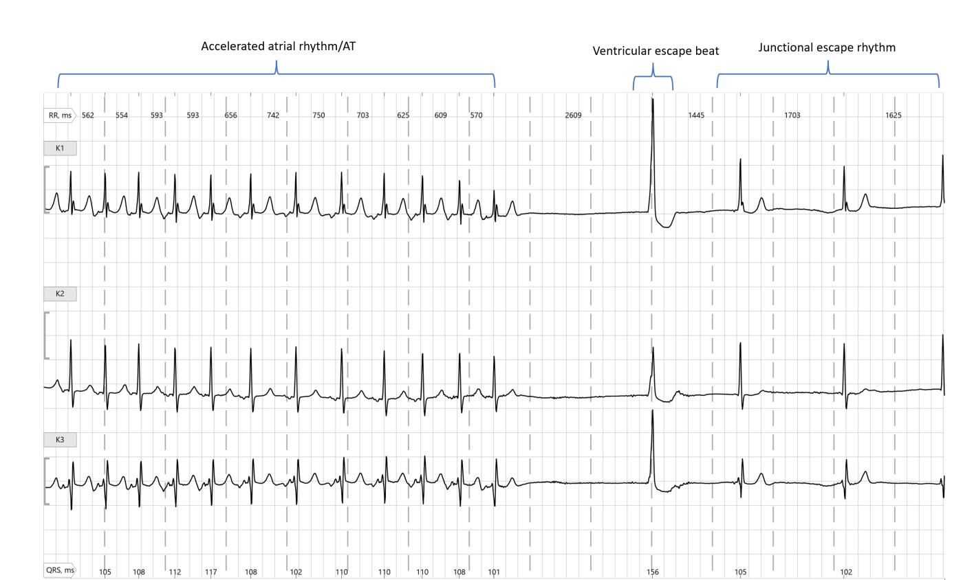 EKG showing sick sinus syndrome with initial atrial tachycardia, followed by a 2609 ms pause, a ventricular beat, and a junctional escape rhythm, demonstrating the alternation between tachycardia and bradycardia.