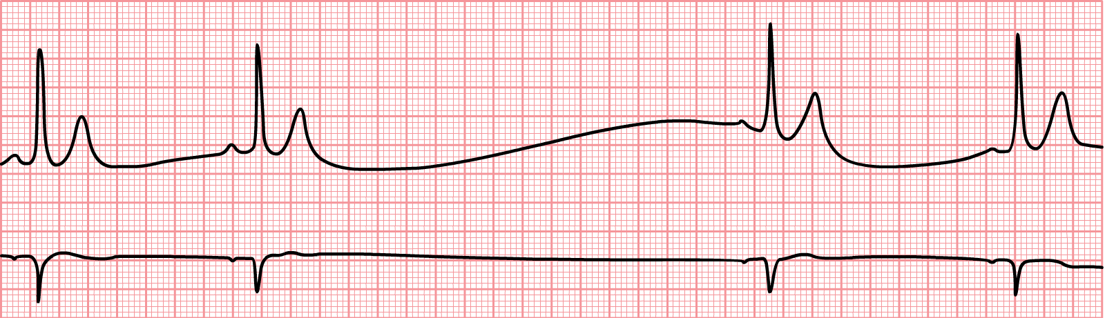 An EKG tracing depicting a sinus pause or sinus arrest, characterized by a sudden absence of P waves an QRS complexes for an extended period, followed by the resumption of normal sinus rhythm.