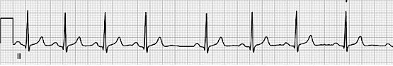 A 6-second rhythm strip of sinus arrhythmia.