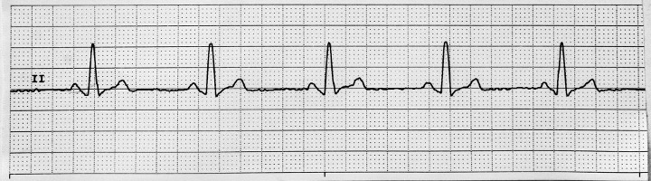 A 6-second rhythm strip displaying sinus bradycardia.