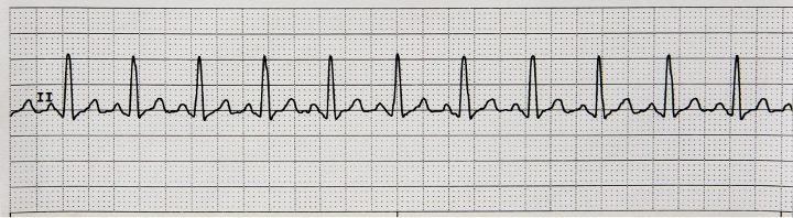 A 6-second rhythm strip displaying sinus tachycardia.