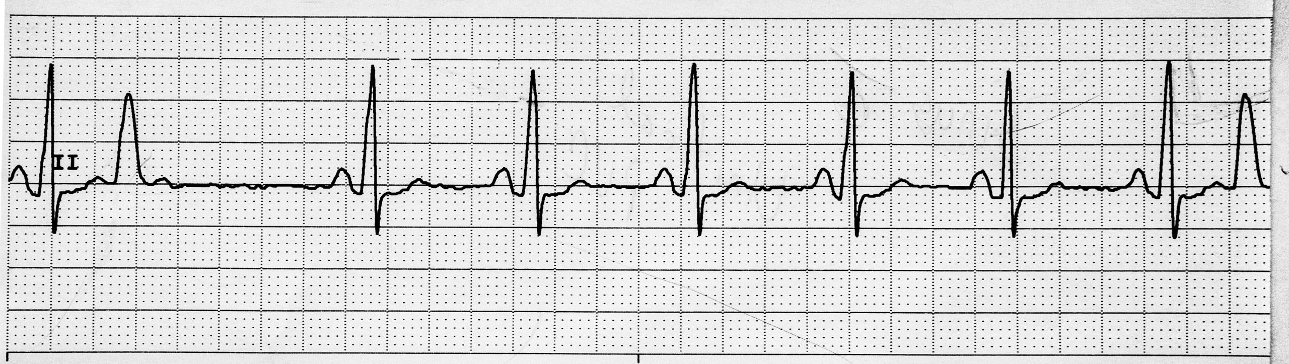 EKG rhythm strip depicting a normal sinus rhythm with the presence of unifocal premature ventricular contractions (PVCs) indicated by wide, early QRS complexes.