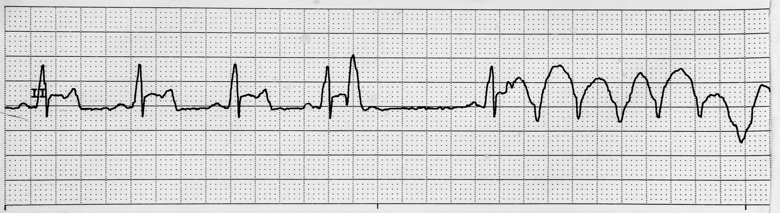 Rhythm strip showing a PVC occur during the T wave leading to ventricular tachycardia (R-on-T phenomenon).