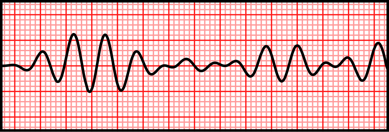 A 3-second rhythm strip illustrating Torsades de Pointes, a form of polymorphic ventricular tachycardia characterized by a twisting of the QRS complexes around the isoelectric line.