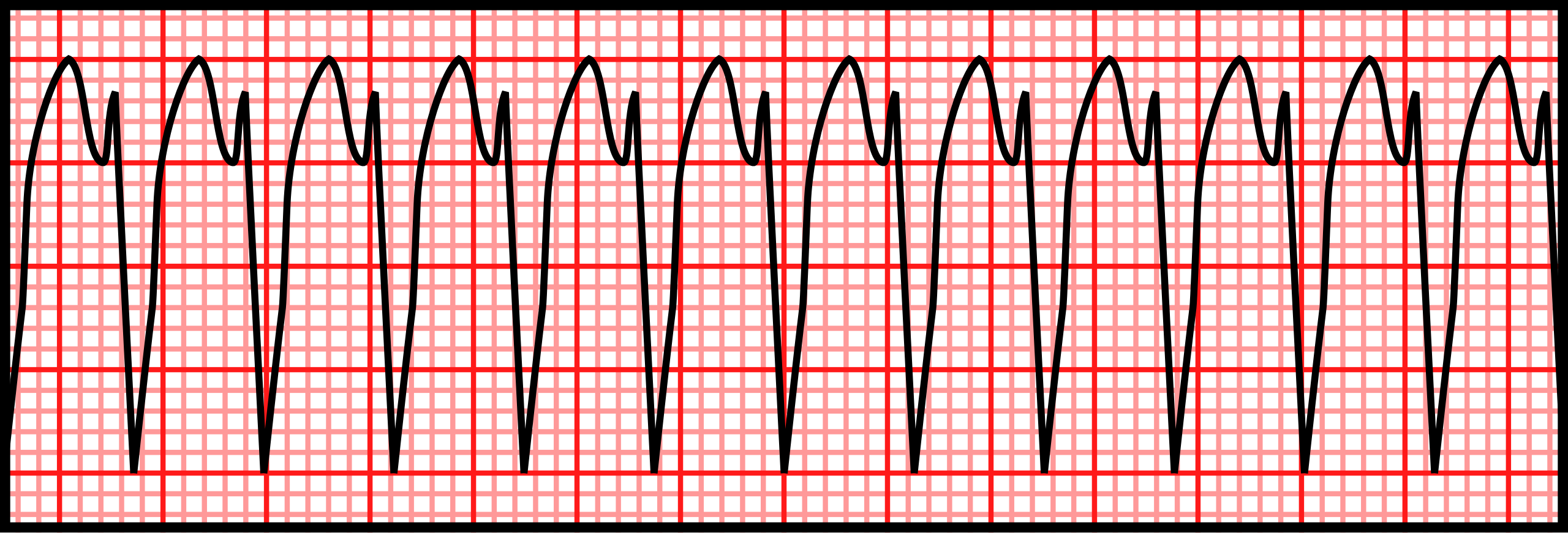 An EKG tracing depicting ventricular tachycardia (V-tach), characterized by wide and rapid QRS complexes.