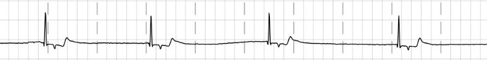 An EKG tracing illustrating a junctional escape rhythm, characterized by regular, narrow QRS complexes and inverted P waves following the QRS complexes. The ECG grid background shows consistent intervals, indicating that the heart's rhythm is originating from the AV junction.