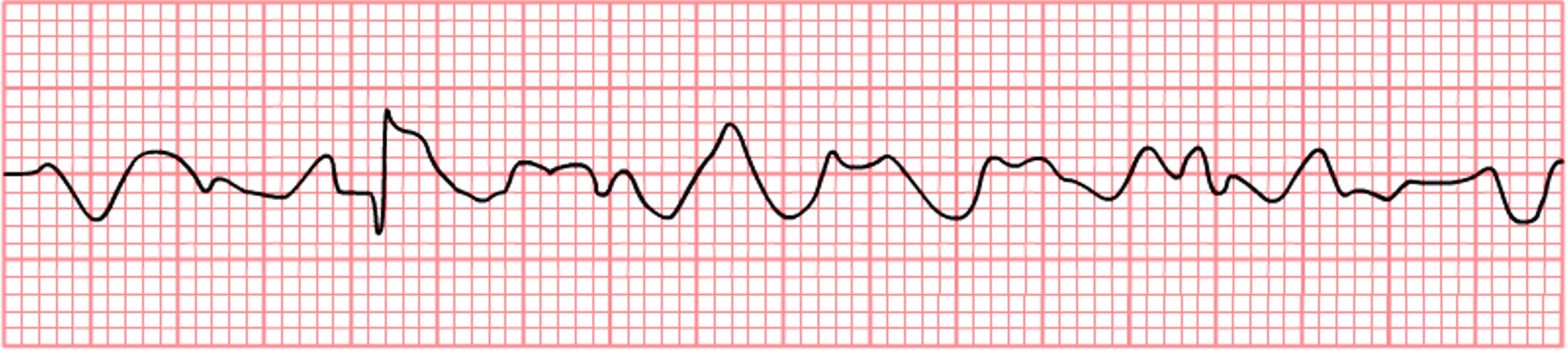 An EKG tracing depicting ventricular fibrillation (V-fib), characterized by rapid and chaotic electrical activity with no organized QRS complexes. The EKG grid background shows the erratic and irregular waveform, lacking any discernible pattern, indicating a severe and life-threatening cardiac arrhythmia.