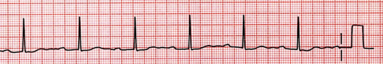 An EKG rhythm strip illustrating 1st-degree atrioventricular (AV) block. The EKG highlights the consistent delay in the PR interval while maintaining a regular rhythm.