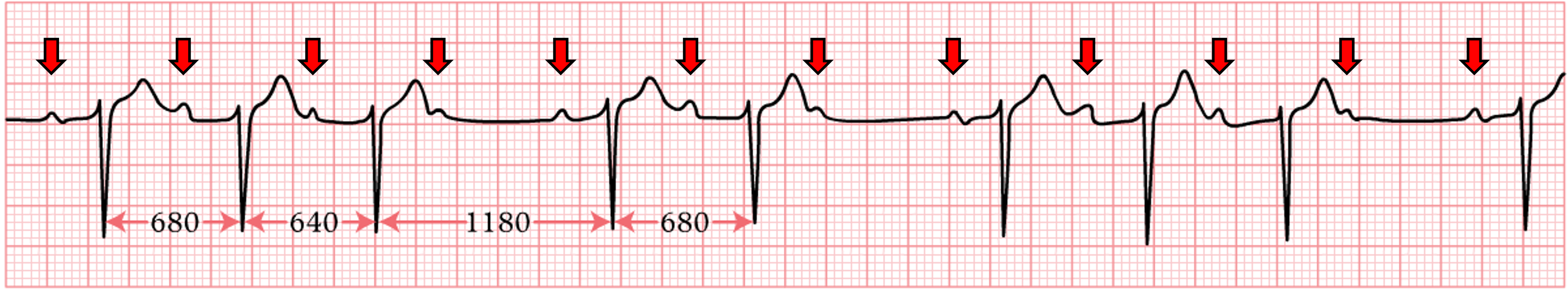 An EKG tracing illustrating 2nd-degree AV block Type I (Wenckebach) showing a progressive lengthening of the PR interval with each successive beat until a P wave is not followed by a QRS complex, resulting in a "dropped" beat.