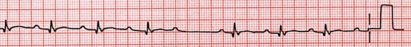 An EKG tracing illustrating second-degree atrioventricular (AV) block Type I, also known as Wenckebach. The tracing shows a progressive lengthening of the PR interval with each successive beat until a P wave is not followed by a QRS complex, resulting in a "dropped" beat. The cycle then repeats, often starting with a shorter PR interval.